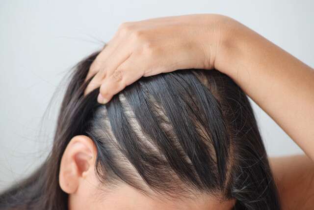 Neglecting Scalp Health