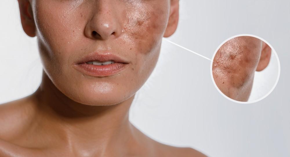 Skin care Hyper-pigmentation remedies