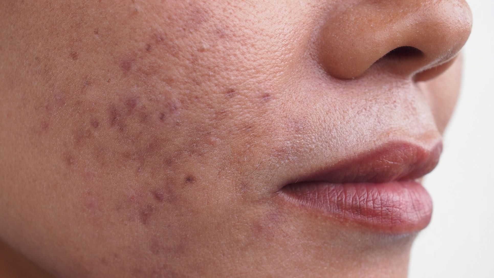 Hyperpigmentation