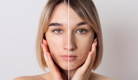 Natural Remedies for Hyperpigmentation