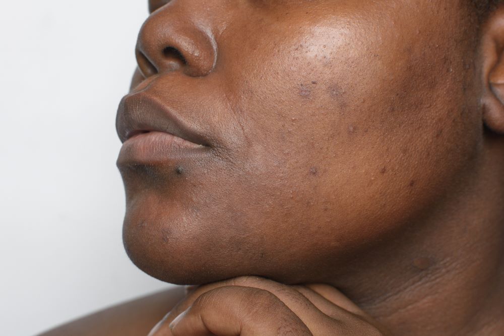 Hyperpigmentation