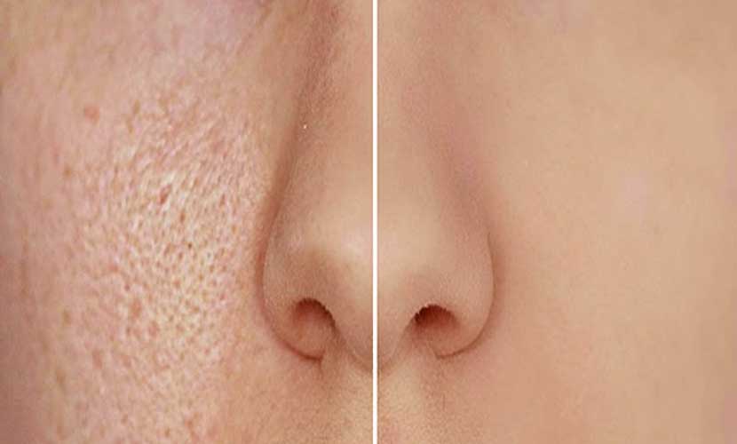 Pores Can Open and Close