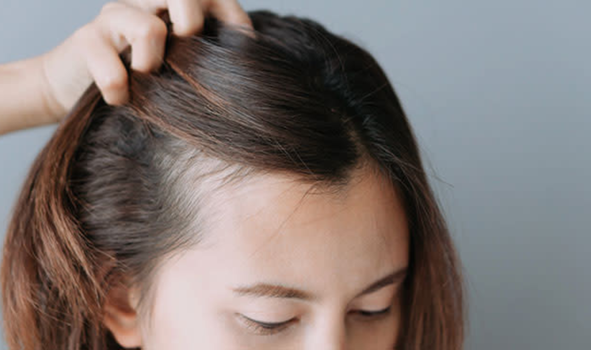 Postpartum Hair Loss